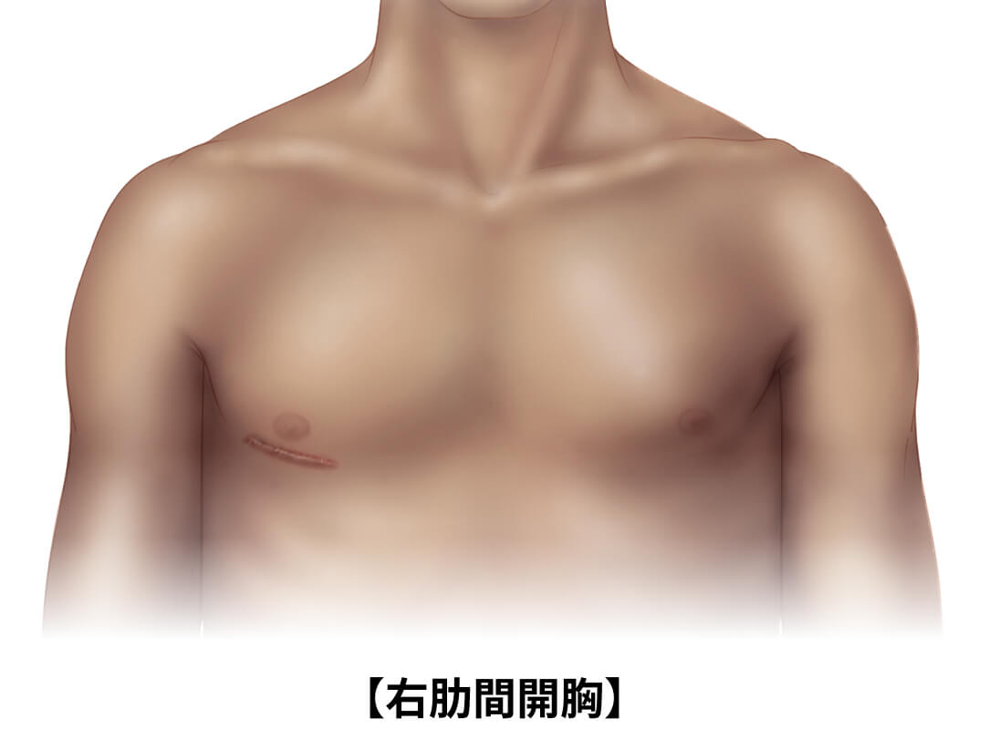 低侵襲心臓手術の基本と実践: 始めたいひとも,始めたひとも
